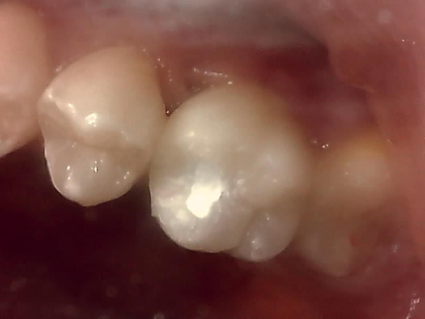 症例 Mtaセメントを用いた直接覆髄法による歯の神経の保存 三好歯科 自由が丘 駅徒歩1分 天然歯を残す
