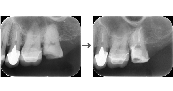 症例 他院での検診で見落とされた大きなう蝕に対する精密根管治療 その2 三好歯科 自由が丘 駅徒歩1分 天然歯を残す
