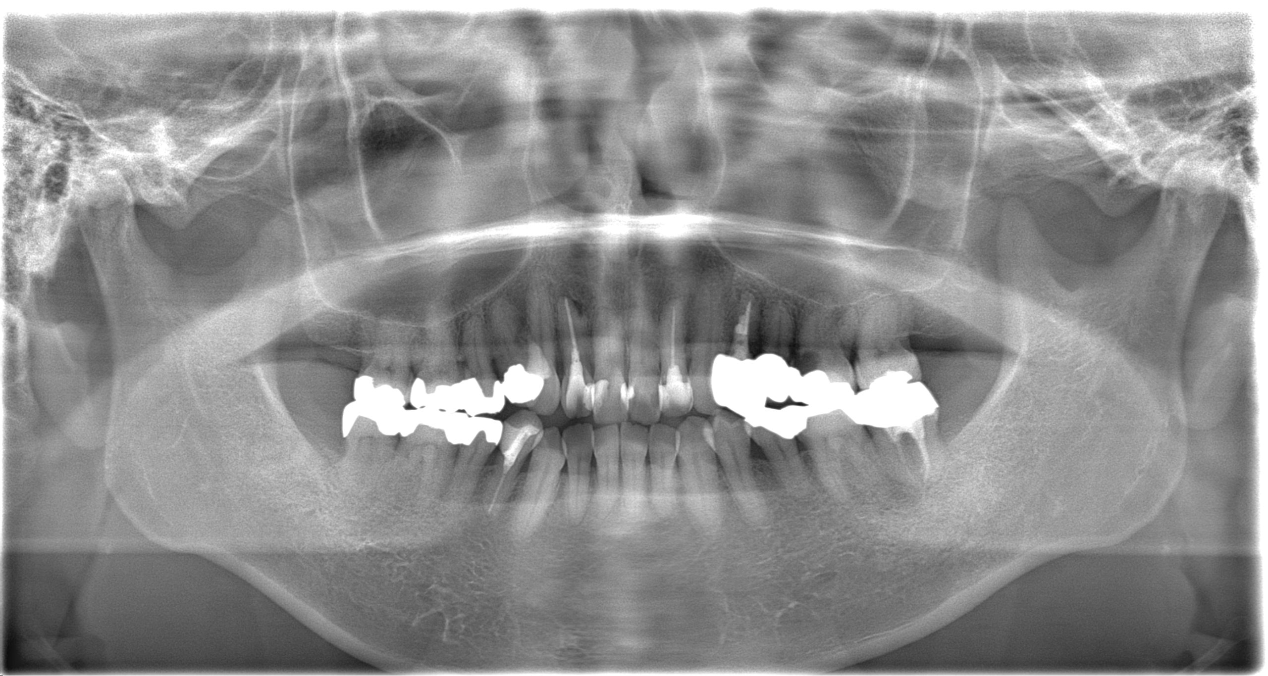 症例 他院での検診で見落とされた大きなう蝕 虫歯 に対する精密根管治療 三好歯科 自由が丘 駅徒歩1分 天然歯を残す