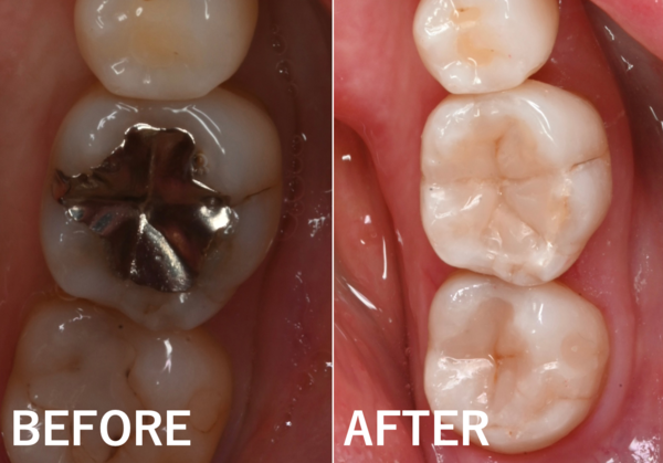 【症例】銀歯の下からの虫歯をダイレクトボンディングにて修復した症例