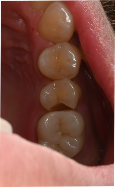 自由が丘の歯医者 三好歯科 自由が丘｜【症例】気づきにくい小臼歯部の虫歯に対してダイレクトボンディングで治療した症例 ｜ダイレクトボンディング前の写真