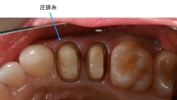 自由が丘の歯医者 三好歯科 自由が丘｜【症例】大きな虫歯に対して根管治療とジルコニアクラウンで治療した症例｜画像20