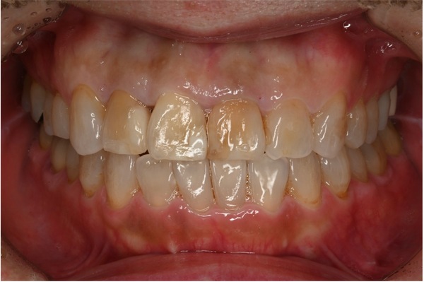 自由が丘の歯医者 三好歯科 自由が丘｜【症例】矯正治療終了後に前歯の審美障害をオールセラミッククラウンにて修復｜治療前